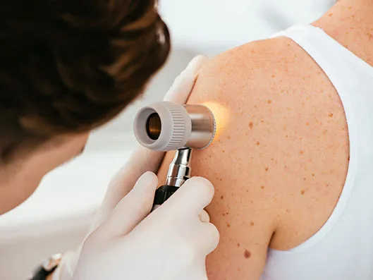 Doctor performing a skin cancer check with a dermatoscope in Surfers Paradise